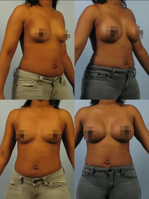 A woman is shown in a four-panel before-and-after photo of breast augmentation surgery, standing in various angles with her breasts pixelated for modesty.