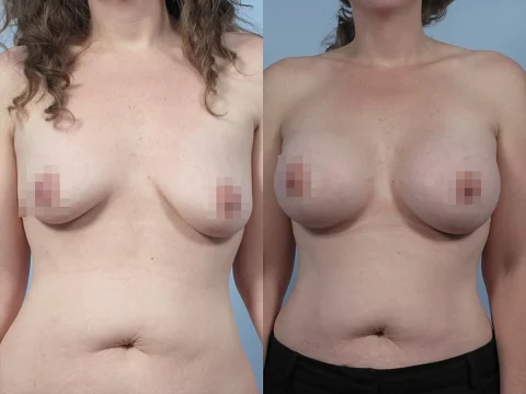 Side-by-side before and after images of a woman showcasing breast augmentation results. The image on the left shows the woman pre-surgery, while the image on the right shows the post-surgery outcome.