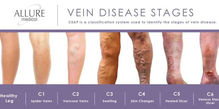 Image showing six stages of vein disease from healthy leg, spider veins, varicose veins, swelling, skin changes, healed ulcer to venous stasis, based on the CEAP classification system.