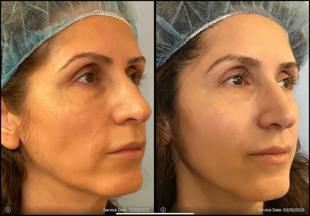 Side-by-side images of a woman's face before and after a cosmetic procedure, showing improved skin texture and tone. Dates are 12/02/2022 and 03/18/2023.