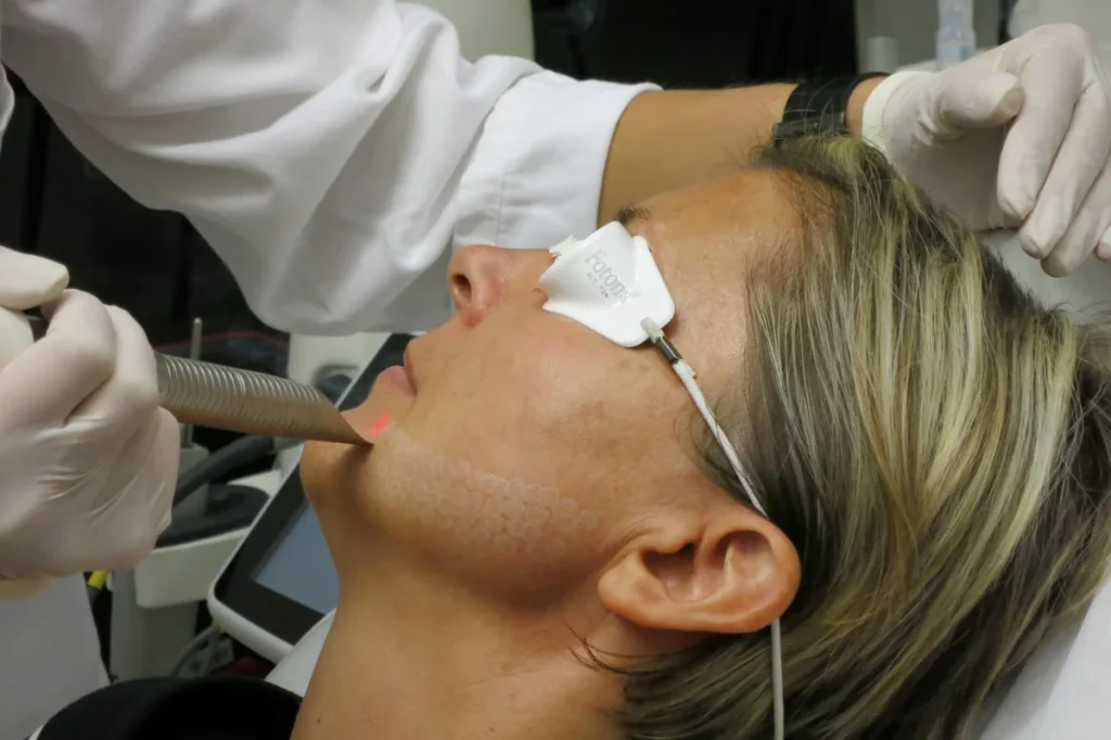 A person receives a laser treatment on their face, wearing protective eyewear. A healthcare professional operates the laser device.