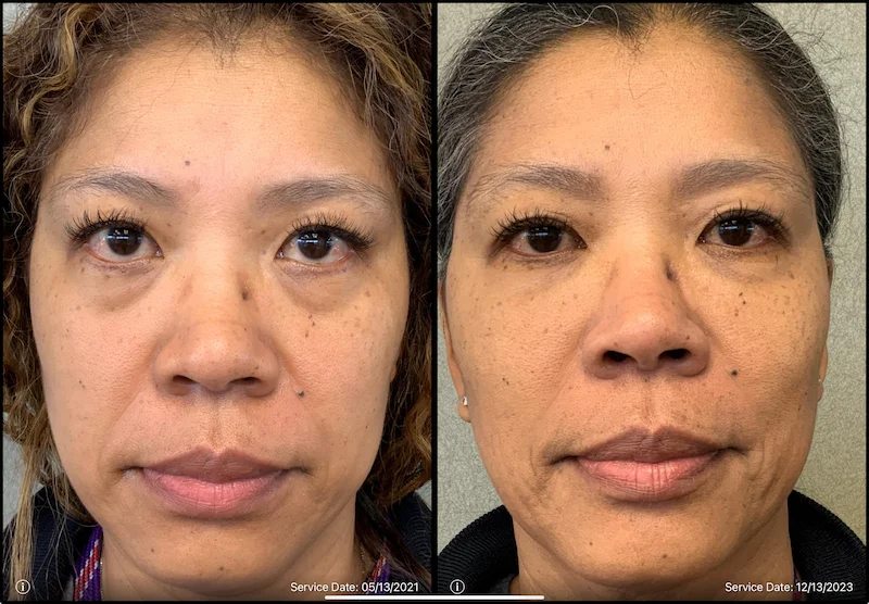 Before and after images of a woman's face, showing changes in skin appearance between May 2021 and December 2023.