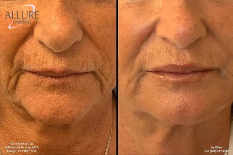 Side-by-side comparison of an older woman's lower face before (left) and after (right) a cosmetic procedure. The after image shows reduced wrinkles and fuller lips.