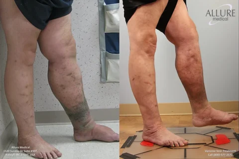 Before and after images of legs with varicose veins treatment, showing significant improvement in skin appearance and vein visibility.