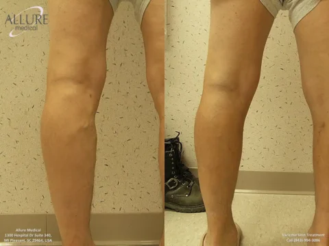 Side-by-side comparison of legs before and after varicose vein treatment, showing reduced vein visibility and smoother skin. Contact information displayed for Allure Medical.