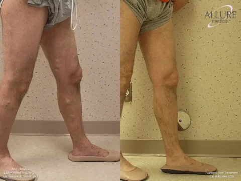 Two side-by-side photos show before-and-after treatment of varicose veins on a person's legs at Allure Medical. The left leg in the left image has visible varicose veins, which are absent in the right image.