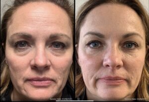 Side-by-side images of a woman's face before and after a cosmetic procedure. The images show noticeable reduction in under-eye bags and smoother skin in the after photo. Service dates: 02/18/2021 and 03/18/2021.