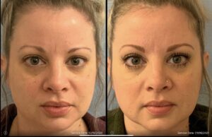 Before and after images of a woman showing changes in her facial appearance, focusing on areas around the eyes and skin texture. Service dates visible: 12/19/2020 and 01/09/2021.