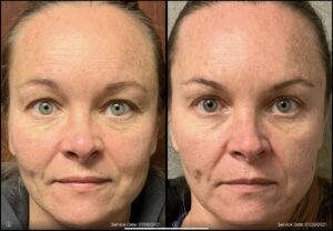 Side-by-side comparison of a woman's face before (left) and after (right) treatment, dated 01/06/2021 and 01/20/2021, respectively. Differences in skin texture and expression are visible.