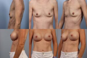 Before and after images showing breast augmentation on a person, with side and front views for each stage. Both images depict a medium skin tone person in white pants against a plain blue background.