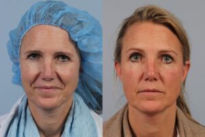 Two side-by-side photos of a woman showing before and after images of a procedure. In the left image, she wears a blue hair net and white coat; in the right image, she wears casual clothing.
