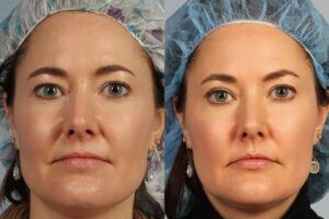 Two side-by-side close-up images of a woman with earrings wearing a surgical cap. The left image shows her with a multi-colored cap, and the right image shows her with a blue cap.