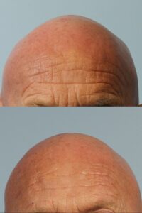 Close-up photos showing the top portion of a bald head with visible skin texture, wrinkles, and slight redness; the top and bottom images capture slight differences in lighting and angles.