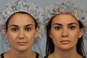 Side-by-side photos of a woman's face before (left) and after (right) a cosmetic procedure, wearing a surgical cap in both images.