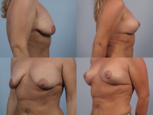 Four images showing a side-by-side comparison of a woman's chest before and after a breast augmentation surgery.