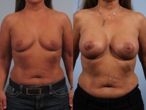 Two photos of a woman's torso are shown side by side for comparison. The image on the right displays changes in the breasts, possibly due to surgery. Both photos show the woman in a similar stance.