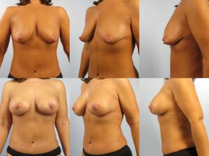 A woman shown in two sets of three images (front, left, and right views) before (top row) and after (bottom row) breast surgery.