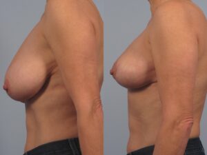 Side-by-side comparison of the side profile of a woman’s upper torso before and after a breast lift surgery, showing visible changes in breast positioning.
