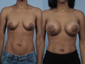 Two side-by-side images show a torso view of a person before (left) and after (right) breast augmentation surgery. The images highlight the changes in breast size and shape.