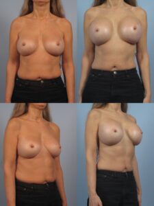 Before and after images of a person showing the results of breast augmentation surgery from front and side views. The top row is the "after" surgery, and the bottom row is the "before" surgery.