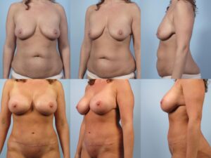 Before-and-after photos showing a woman from front, three-quarter, and side views. Top row: pre-surgery, bottom row: post-surgery, with visible changes in breast size and abdominal contour.
