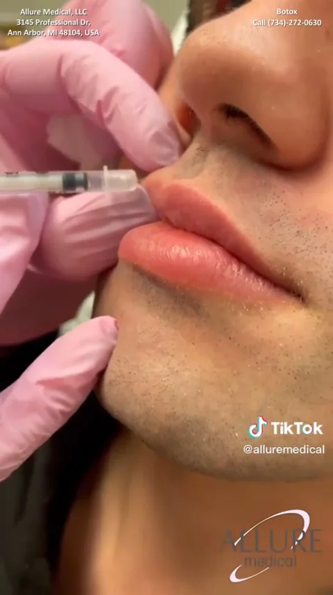 A close-up of a person receiving a cosmetic injection in the upper lip area. Pink gloves are worn by the administrator. Text on the image includes contact information for Allure Medical.