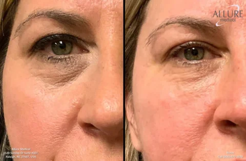 Side-by-side close-up of a woman's eyes before (left) and after (right) a cosmetic procedure. The right image shows smoother skin around the eye area. Allure Medical branding is visible.