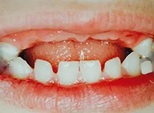 Close-up image of a person's mouth showing misaligned and uneven teeth with gaps. The gums and tongue are also visible.