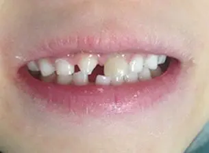 Close-up of a person's mouth showing teeth with noticeable gaps and misalignment.