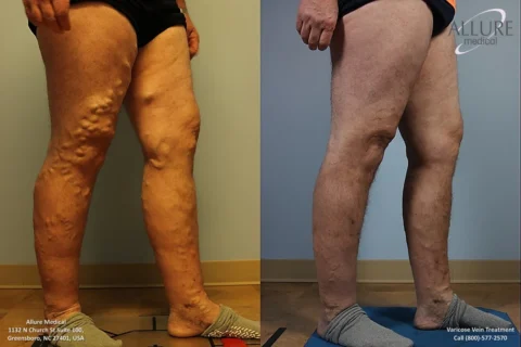 Side-by-side comparison of a person's legs before (left) and after (right) varicose vein treatment, showing significant reduction of visible vein bulging.