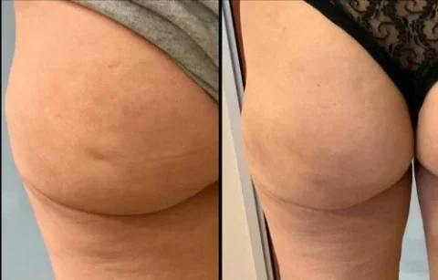 Before-and-after comparison of a person's thigh and buttock area, showing a reduction in cellulite.