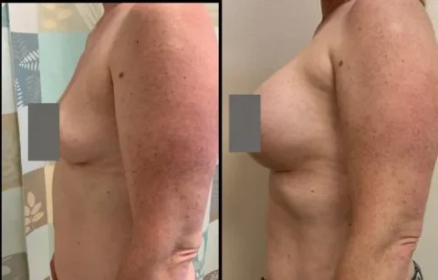 Side-by-side comparison of a person's torso before and after a breast augmentation.