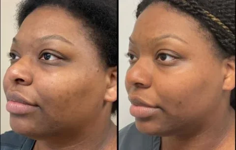 Side-by-side comparison of a woman's face showing before and after skin treatment. The left image shows more blemishes than the right.