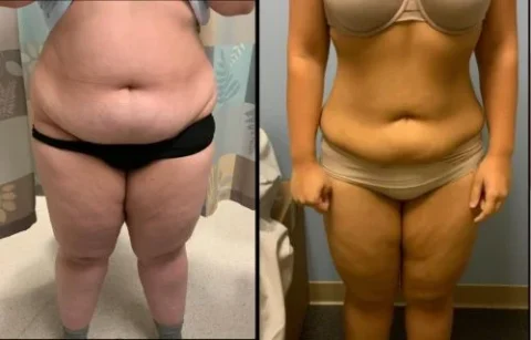 Before and after images of a person showing weight loss, wearing undergarments, in a medical setting.