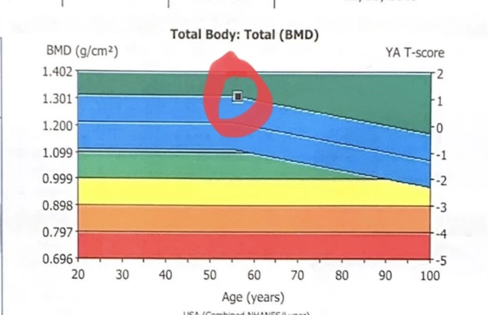 Bone mineral density chart with age on the x-axis and BMD on the y-axis. A red circle marks a specific point on the chart. The chart uses a color gradient from green to red.