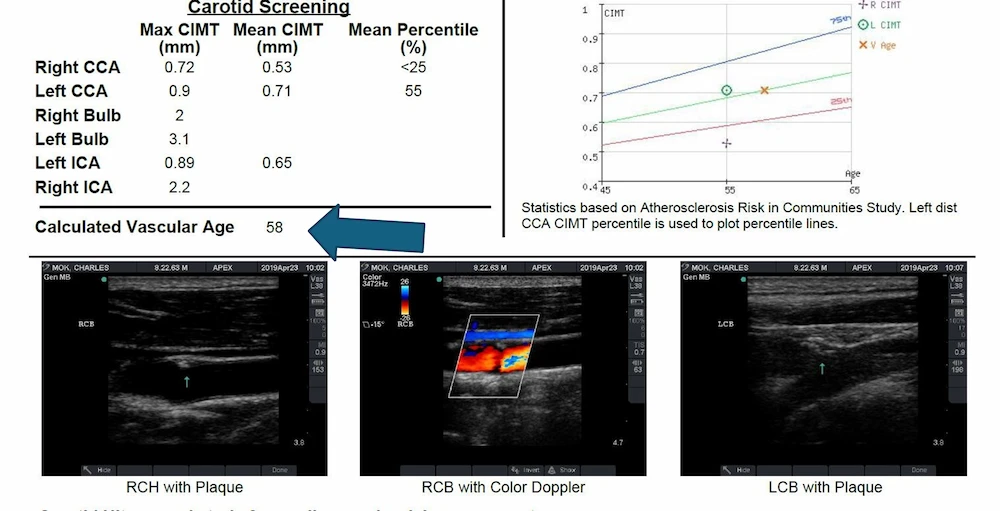 Medical report featuring carotid ultrasound images and screening data, highlighting a calculated vascular age of 58 with labeled ultrasound results displaying tangible information.