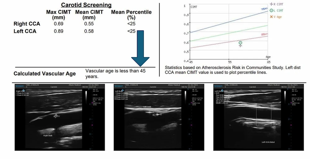 Ultrasound images and data showing carotid screening results, including CIMT measurements and vascular age assessment, indicating a vascular age of less than 45 years.