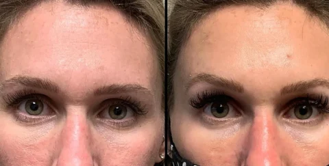Side-by-side close-up of a person's forehead and eyes showing wrinkles before (left) and smoother skin after (right) a cosmetic treatment.