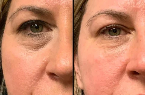 Split image showing a close-up of a woman's face before and after treatment, highlighting reduced wrinkles and smoother skin on the right side.