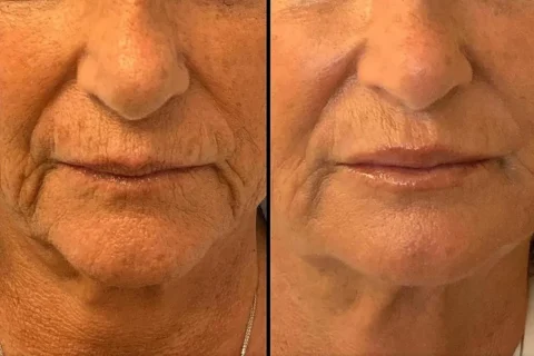Side-by-side close-up of the lower face of an older person, showing more pronounced wrinkles on the left and smoother skin on the right.