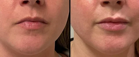 Side-by-side comparison of a woman's lower face, showing smoother, fuller skin and lips in the right image compared to the left.