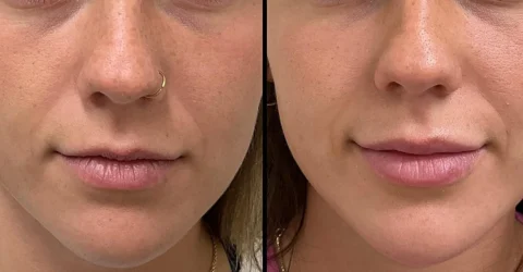 Side-by-side close-up photos showing a person's face before and after a cosmetic procedure, with the after photo displaying fuller lips.