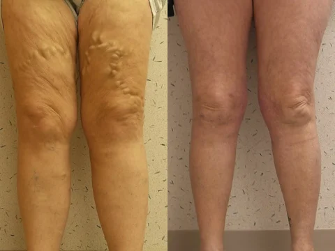 Side-by-side comparison of legs showing varicose veins on the left and the same legs after treatment with smoother skin on the right.