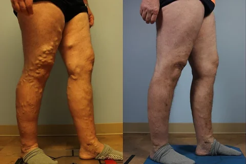 Side-by-side comparison of a person's legs before and after treatment for varicose veins, showing reduced swelling and smoother skin in the after image.