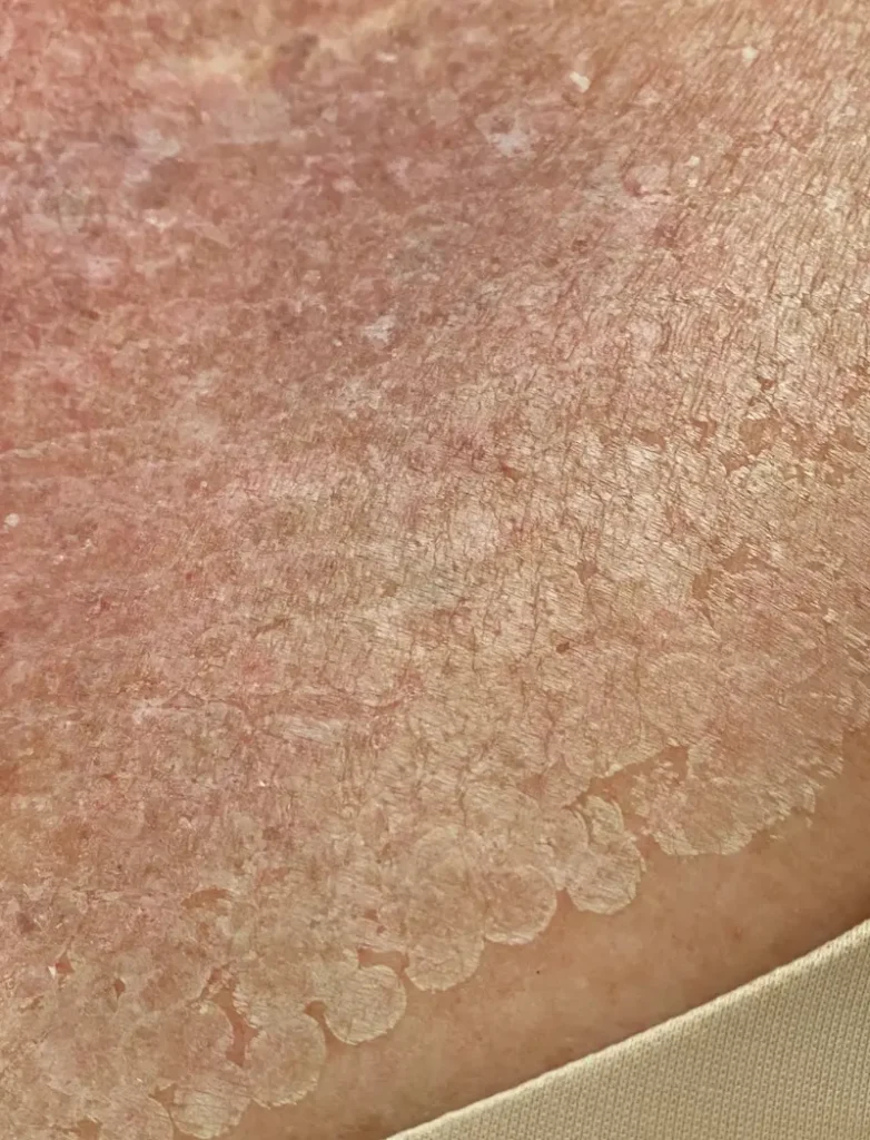 Close-up of dry, flaky, and peeling skin with visible scales and patches of redness near a beige fabric edge.