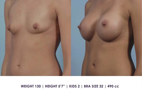 Side-by-side comparison of a woman's bare torso before and after breast augmentation, showing increased breast size; includes weight, height, kids, bra size, and implant volume details below.