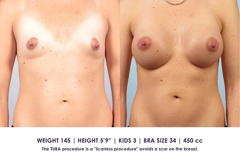 A side-by-side comparison of a topless woman before and after breast augmentation surgery, showing noticeable increase in breast size.