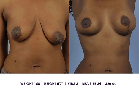 Before and after photos of a woman's torso showing results of breast augmentation; the right image shows fuller, lifted breasts compared to the left. Text below lists physical details and implant size.
