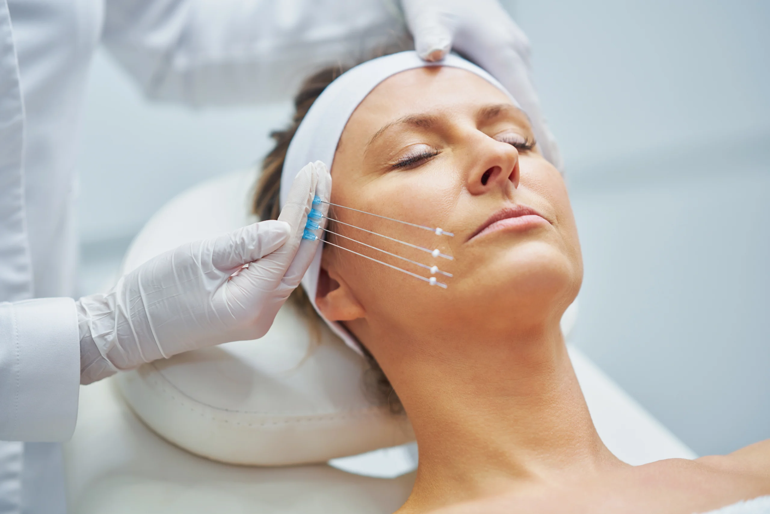 A woman receives a cosmetic thread lift procedure on her face, with a medical professional inserting threads under her skin while she lies with her eyes closed.