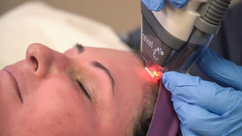 A person receives a facial laser treatment as a technician in blue gloves moves a laser device over their forehead.